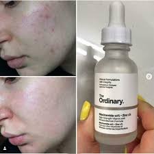 The Ordinary Niacinamide 10% + Zinc 1 % – 30ml |oil Control, Pore Minimizing & Blemish Solution Serum